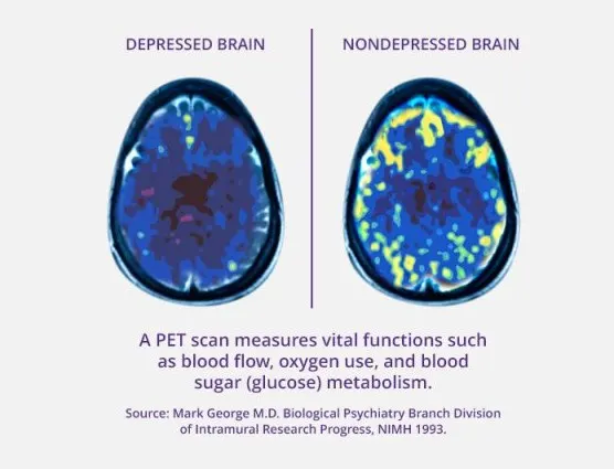 Side-by-side PET scans labelled depressed brain and nondepressed brain, showing lower metabolic activity in the depressed brain.